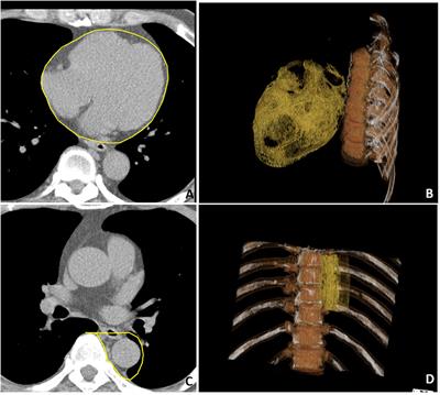 Both epicardial and peri-aortic adipose tissue blunt heart rate recovery beyond body fat mass